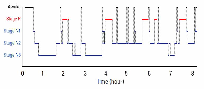 정상수면 패턴awake stage R(렘수면단계)비렘수면단계 stage1, stage2, stage3 (출처: The Physiology of Normal sleep, Hanyang Med Rev 2013;33:190-196)